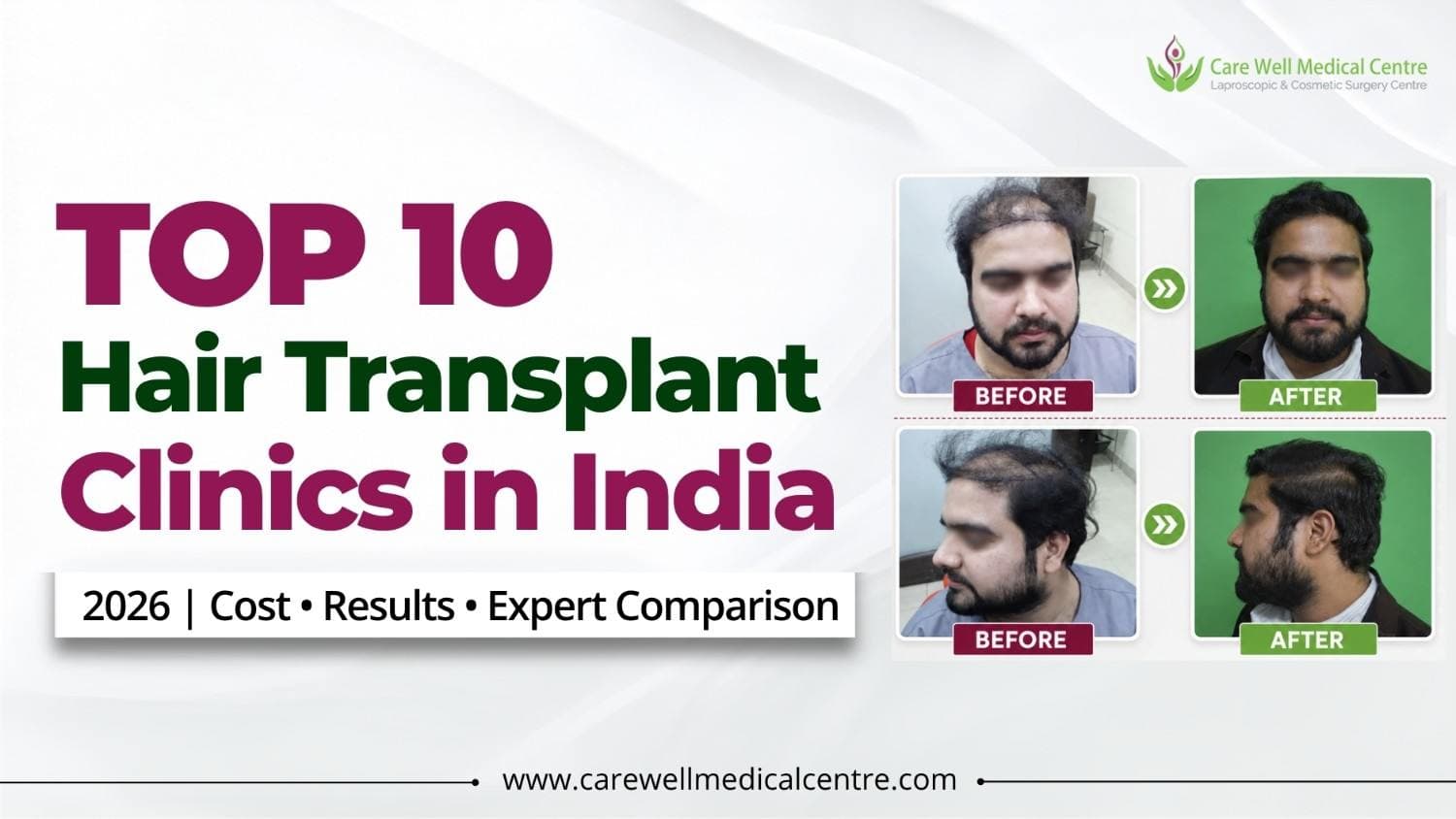 Top 10 Best Hair Transplant Clinics in India 2026