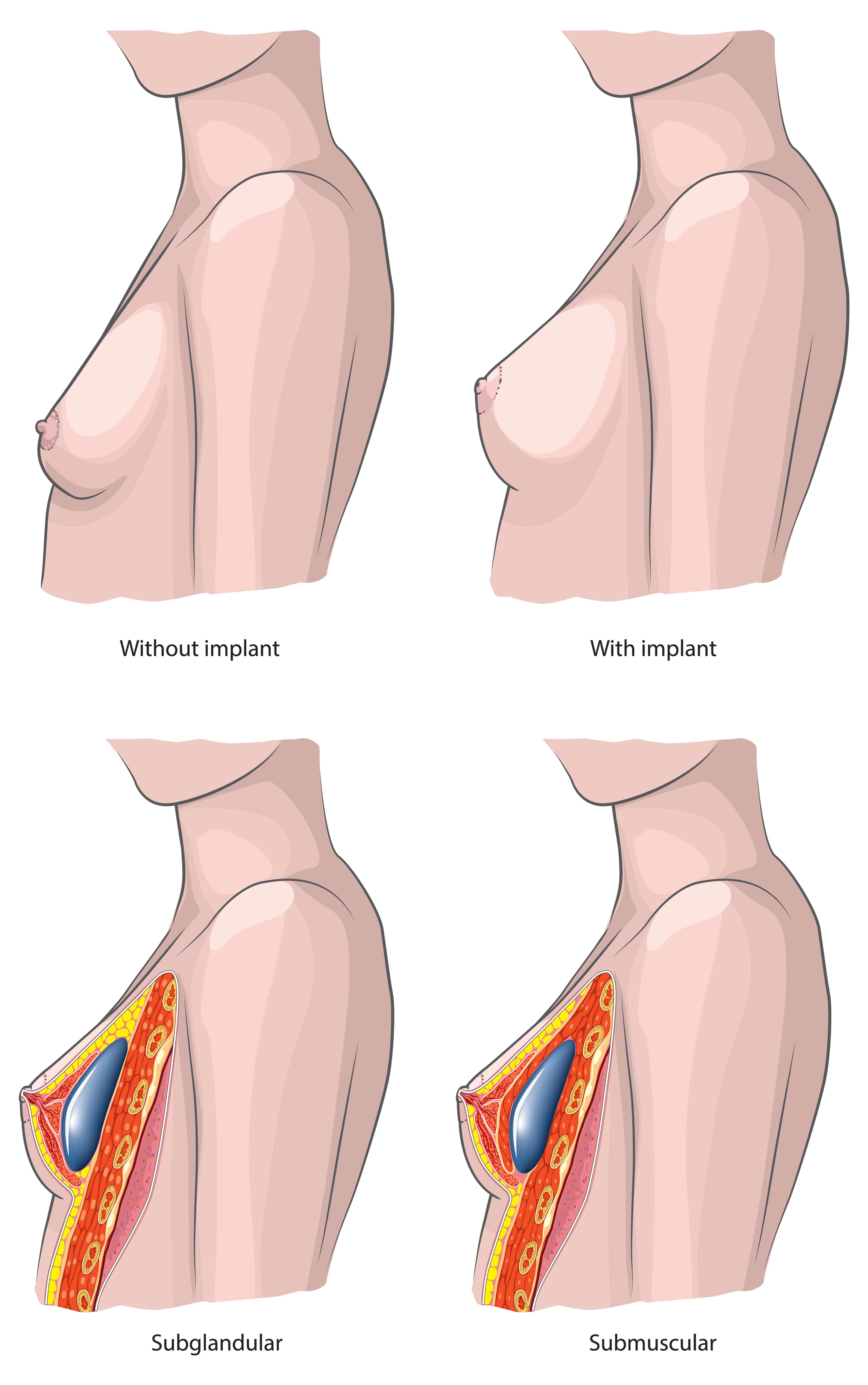 Breast after surgery