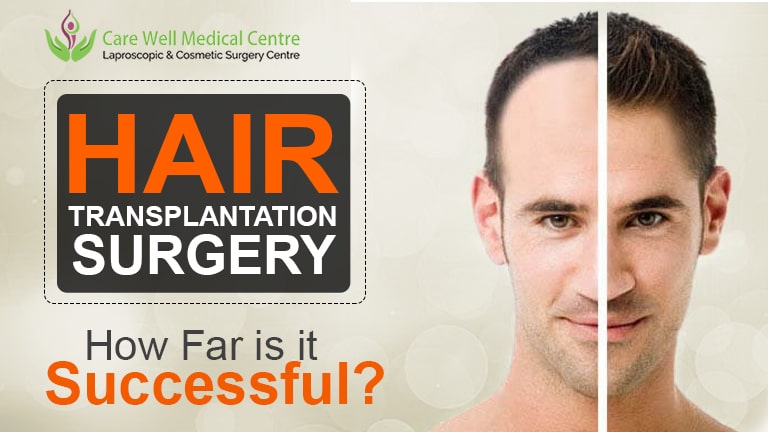 How Really Successful is Hair Transplant Surgery? Then Decide | Care Well  Medical Centre