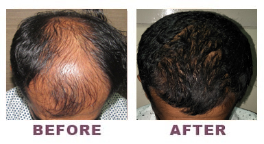 Hair Transplant Before & After Photo