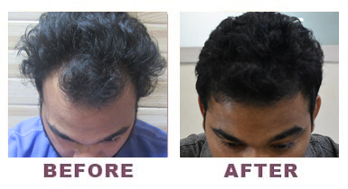 Hair Transplantation Before and After Photo