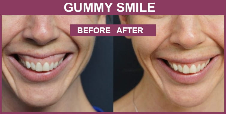 How to Fix Gummy Smile Correction with Best Treatment? | Care Well ...