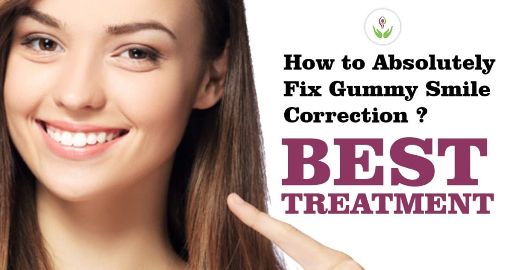 gummy-smile-treatment-1024x536.jpg