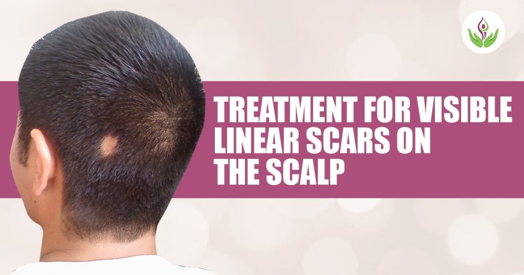 Scalp-Linear-Scars-Treatment-1024x538.jpg