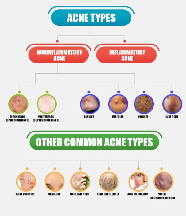 Types of Acne – Everything You Need to know | Care Well Medical Centre