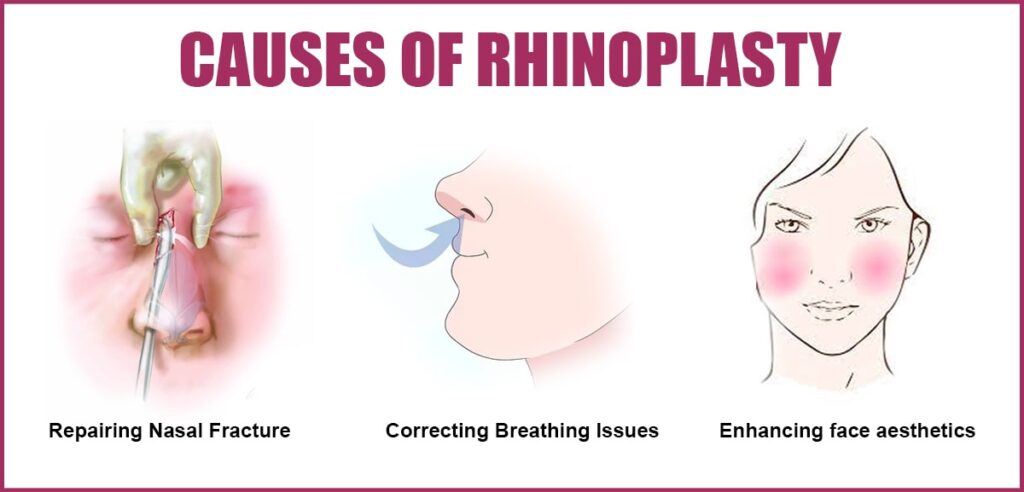 Causes of Rhinoplasty 