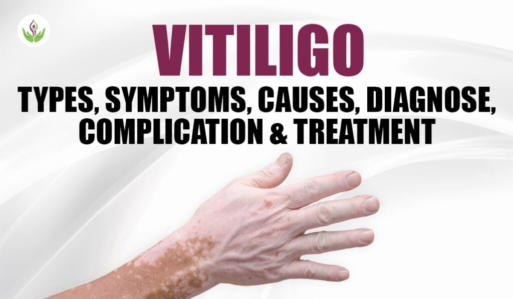 vitiligo-types-symptoms-treatment-causes-1024x597.jpg