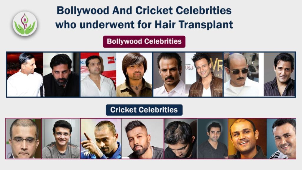 Bollywood-And-Cricket-Celebrities-who-underwent-Hair-Transplant-1024x576.jpg