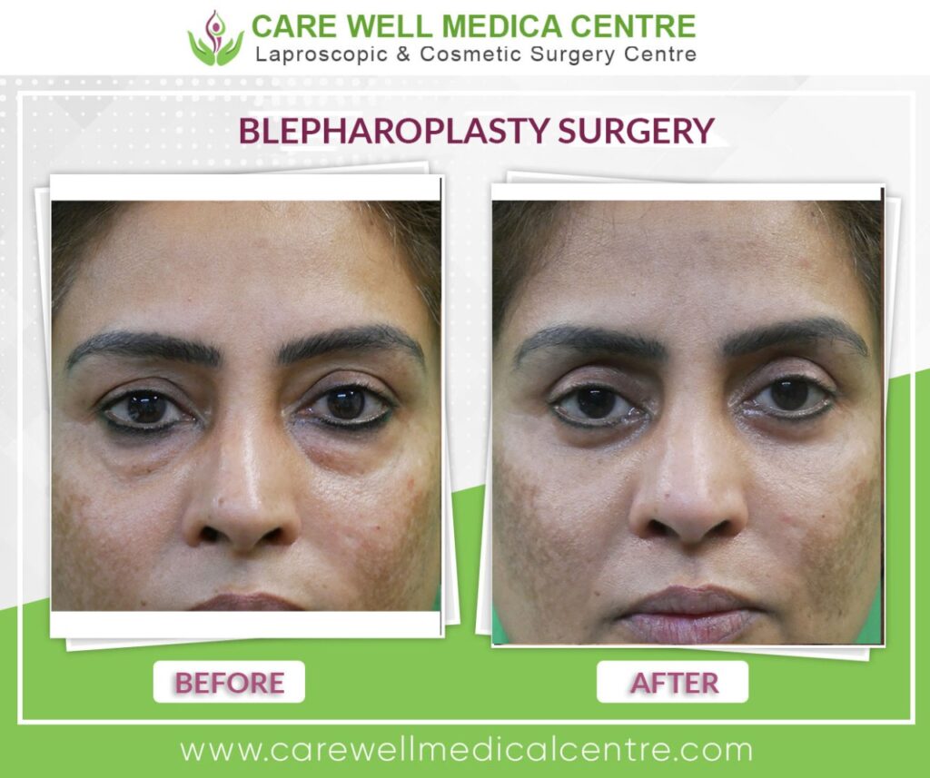 Blepharoplasty Before and After Result
