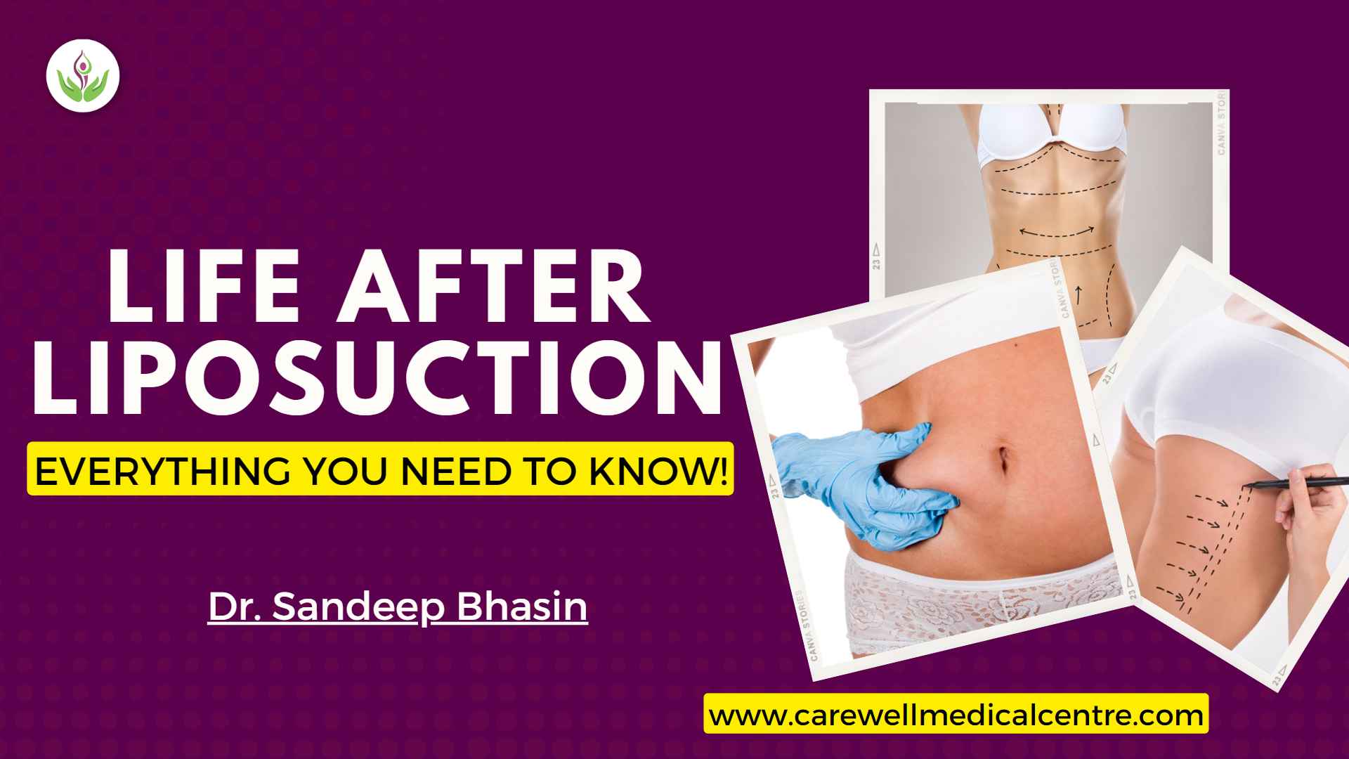 Benefits of Wearing Compression Garments after Liposuction, Liposuction in  Delhi