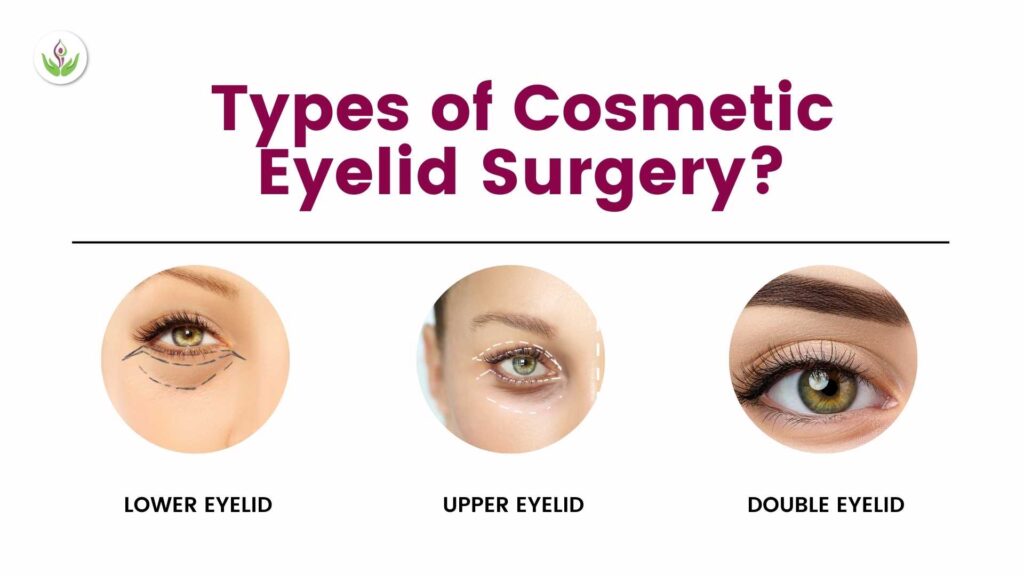 Types of Eyelid Surgery