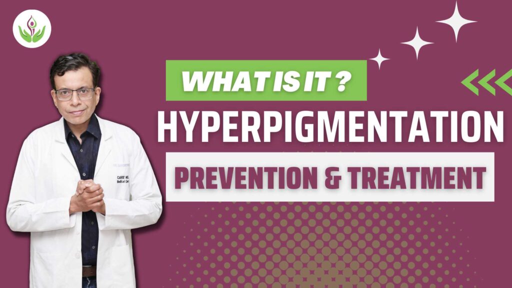 Hyperpigmentation-What-Is-It-And-How-Can-You-Prevent-Or-Treat-It-min-1024x576.jpg