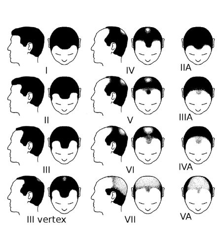 Partial Norwood scale for male pattern baldness