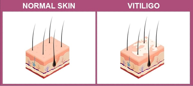 Vitiligo Treatment, Delhi, Skin Revitalization