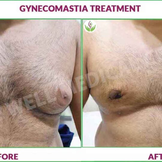 gynecomastia before and after photo