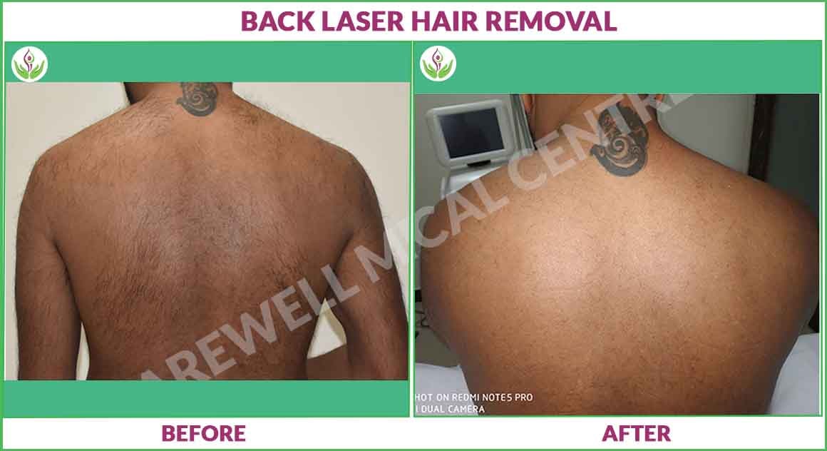 Back laser hair removal before and after result photo