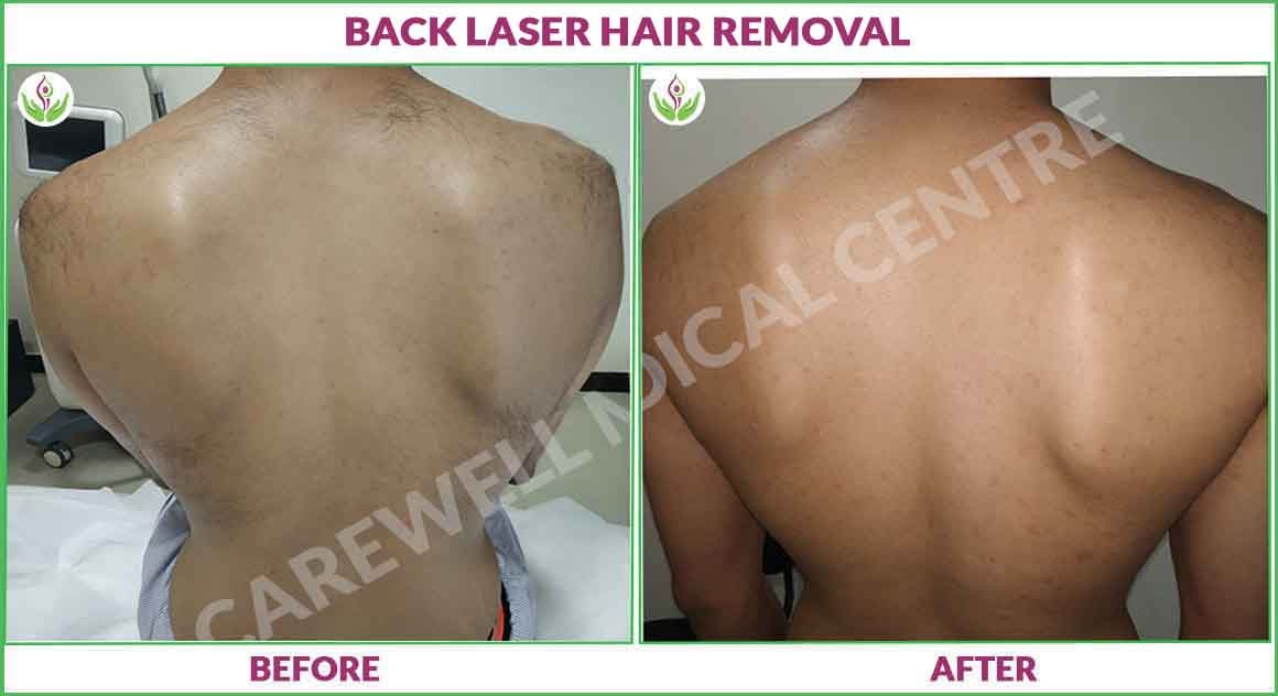 Back laser hair removal before and after photo