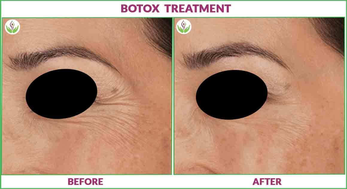 Botox treatment before and after Image