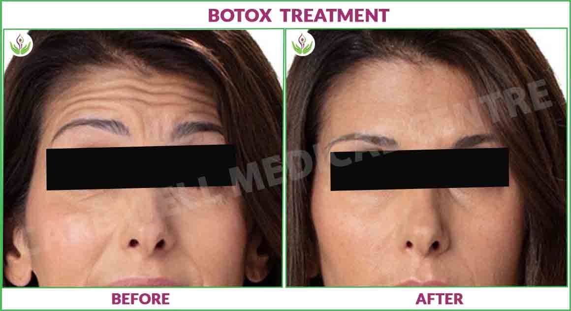 Botox treatment before and after photo