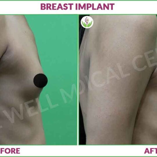 Breast Implant before and after Image