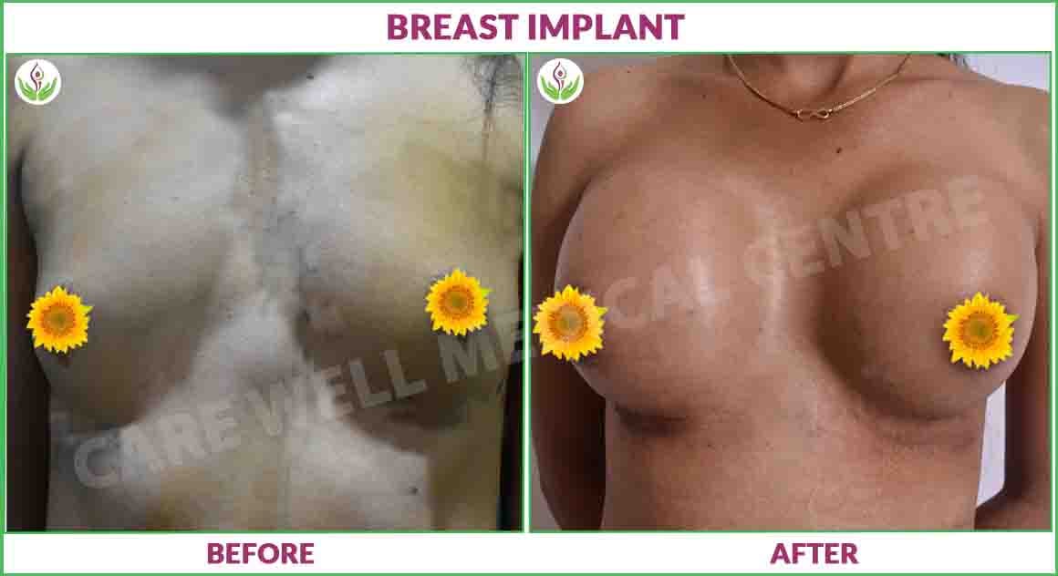 breast implant before and after photo