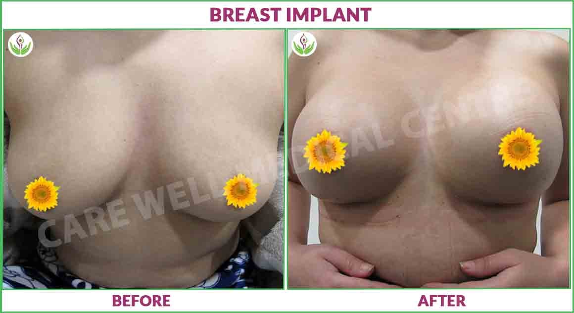 breast implant before and after photo