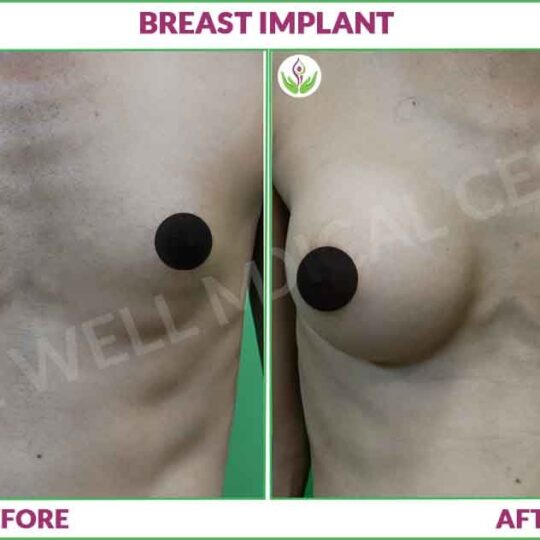 Breast Implant before and after Photo