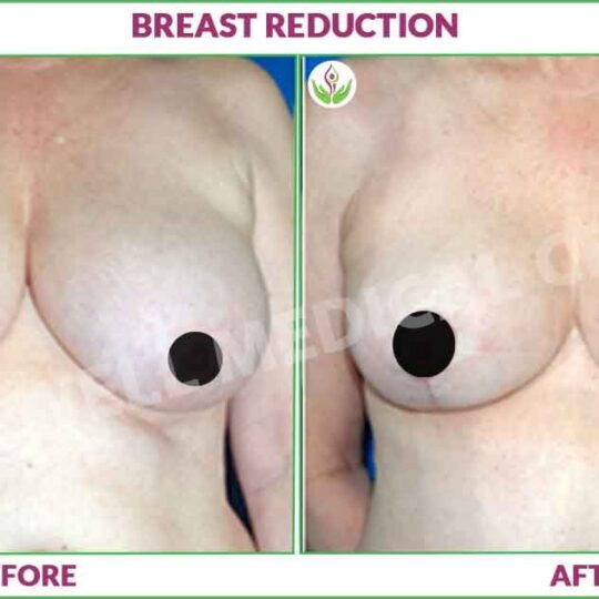 breast reduction before and after results Image