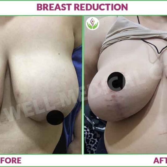 breast reduction before and after results photo