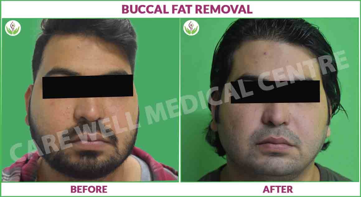 buccal fat removal before and after image