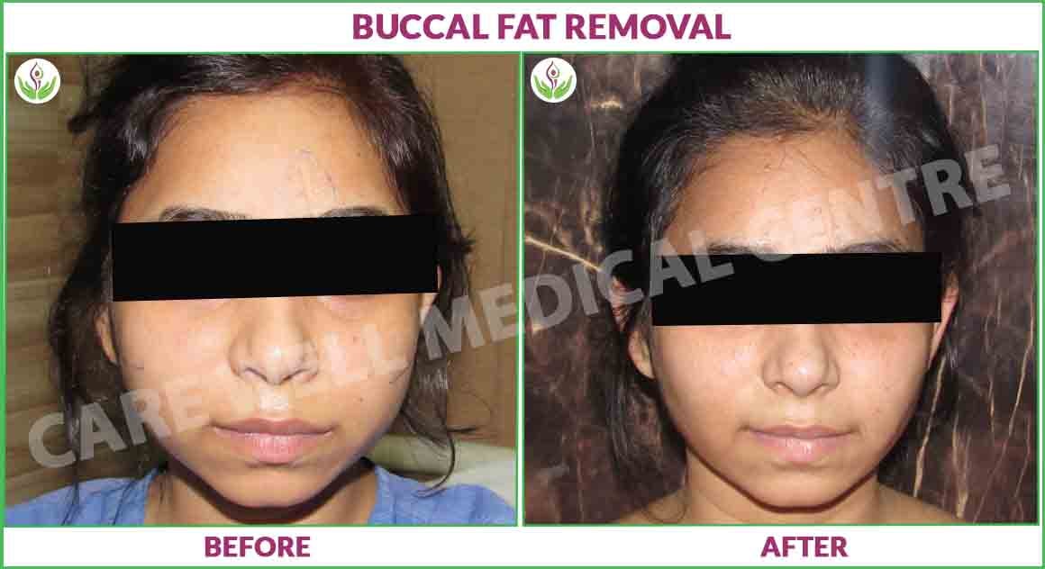 buccal fat removal before and after photo