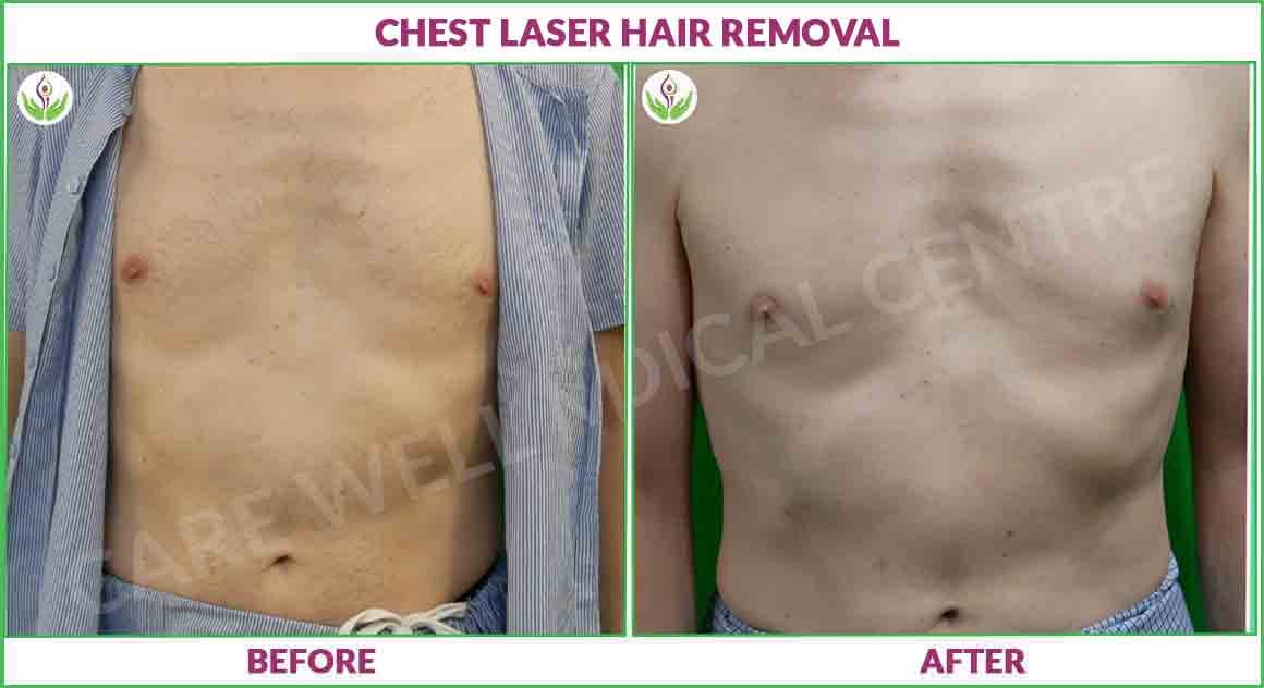 Back laser hair removal before and after results image