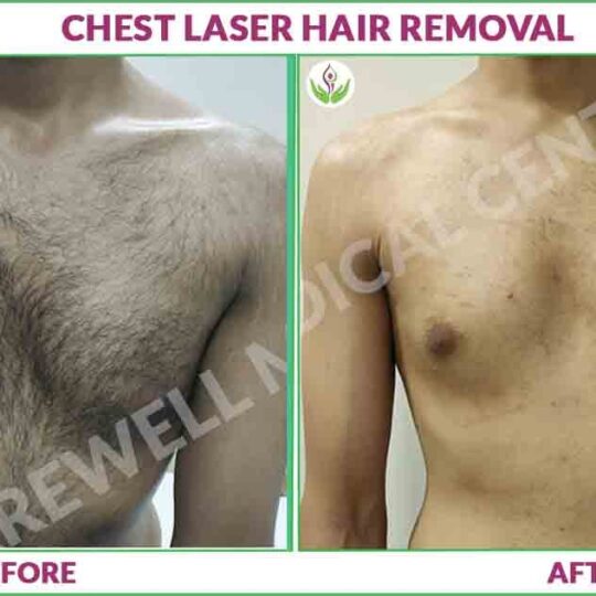 Back laser hair removal before and after results photo