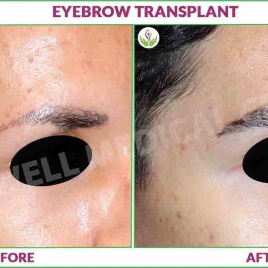 Eyebrow Transplant Before and After Image