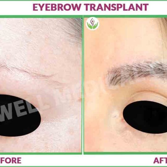 Eyebrow Transplant Before and After Photo