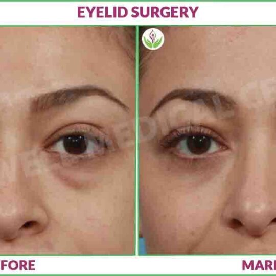 eyelid surgery before and after photo