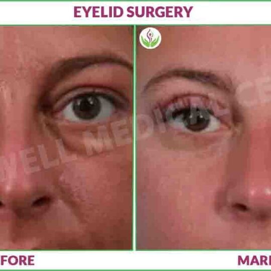 eyelid surgery before and after photo