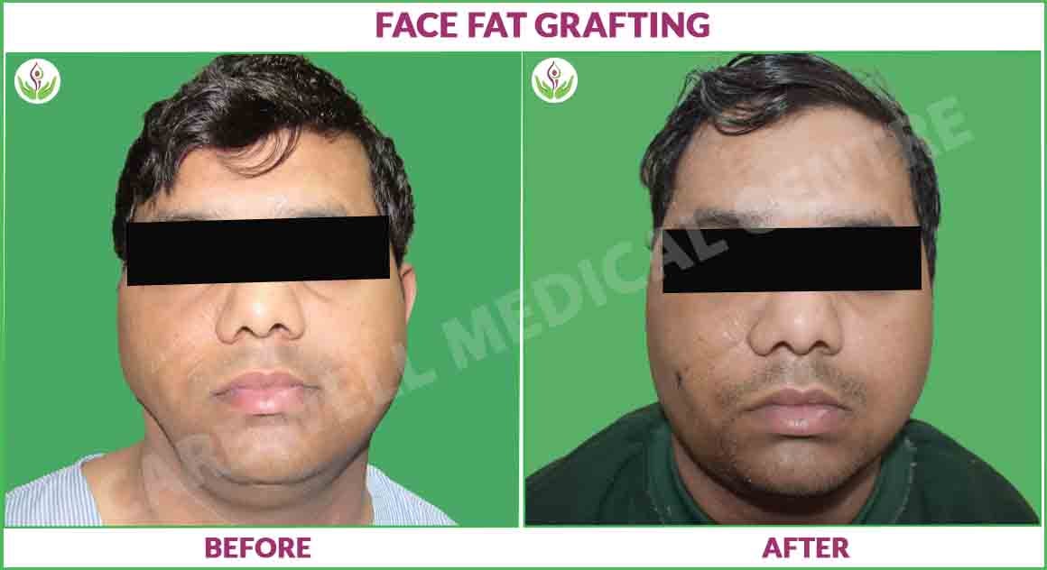 face fat grafting before and after photo