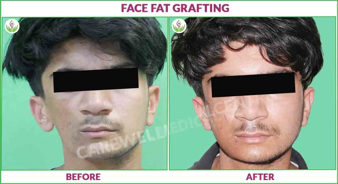 face fat grafting before and after photo