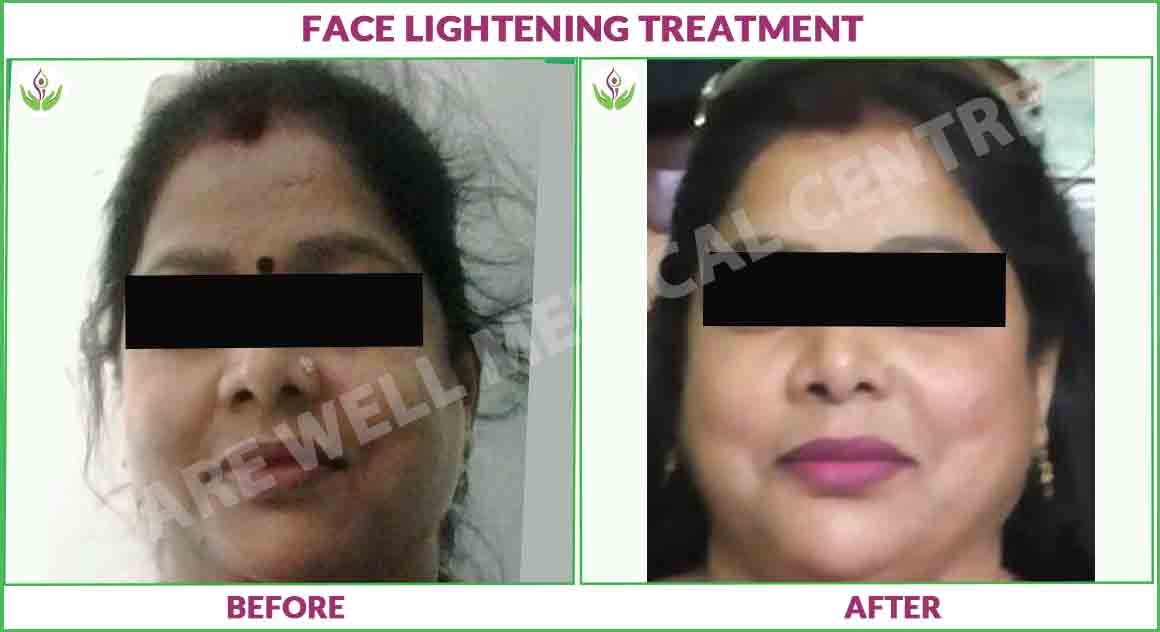 face lightning treatment before and after photo