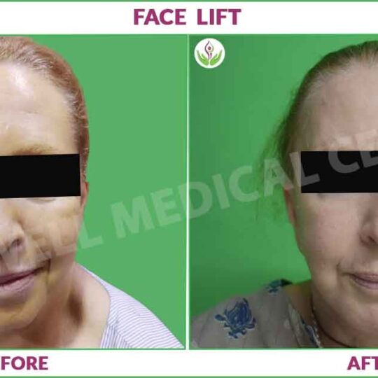 facelift before and after image