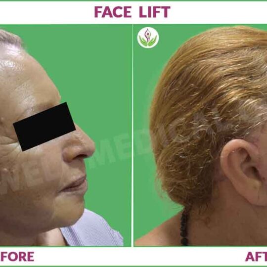 facelift before and after photo