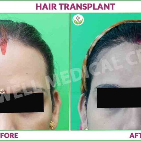 Before and after female hair transplant in Delhi showing natural results