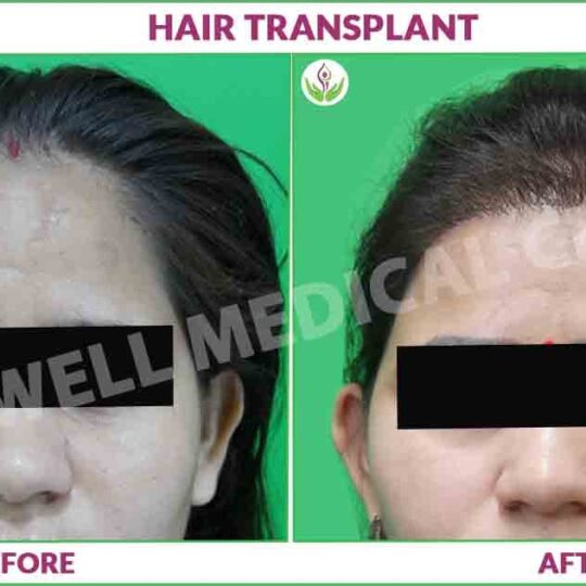 female hair transplant before and after photo