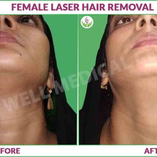 female laser hair removal before and after results photo