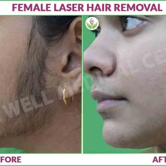 female laser hair removal before and after result photo