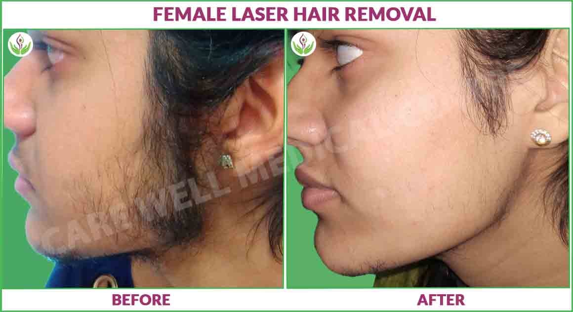 female laser hair removal before and after result