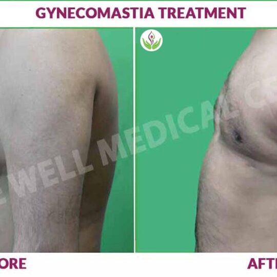 gynecomastia before and after result Image