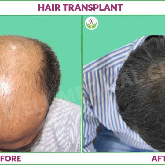 Hair Transplant Before and After Results Image in Delhi