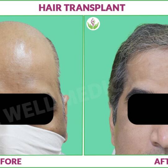 Hair Transplant Before and After Results in Delhi